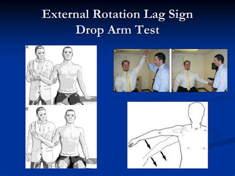 drop-arm test|positive hornblower's sign.